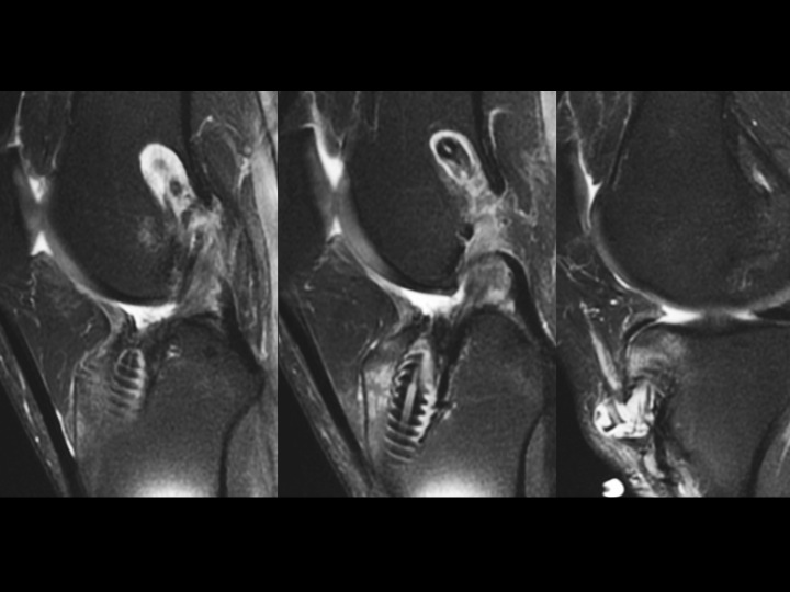 Figure 3 for case ACL graft device ( RID5523 )